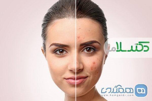 دشمنان آکنه کدام ها هستند؟ دشمنان آکنه کدام ها هستند؟