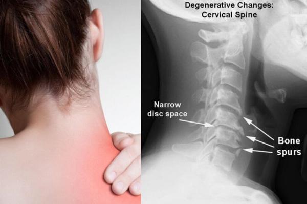 اسپوندیلوز گردنی چیست و چه علائمی دارد؟